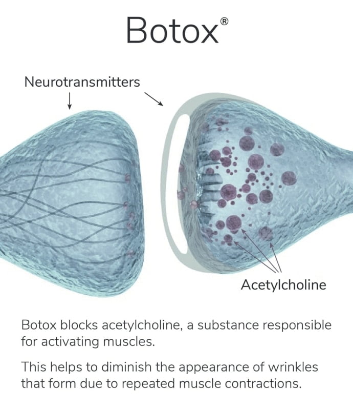 botox diagram