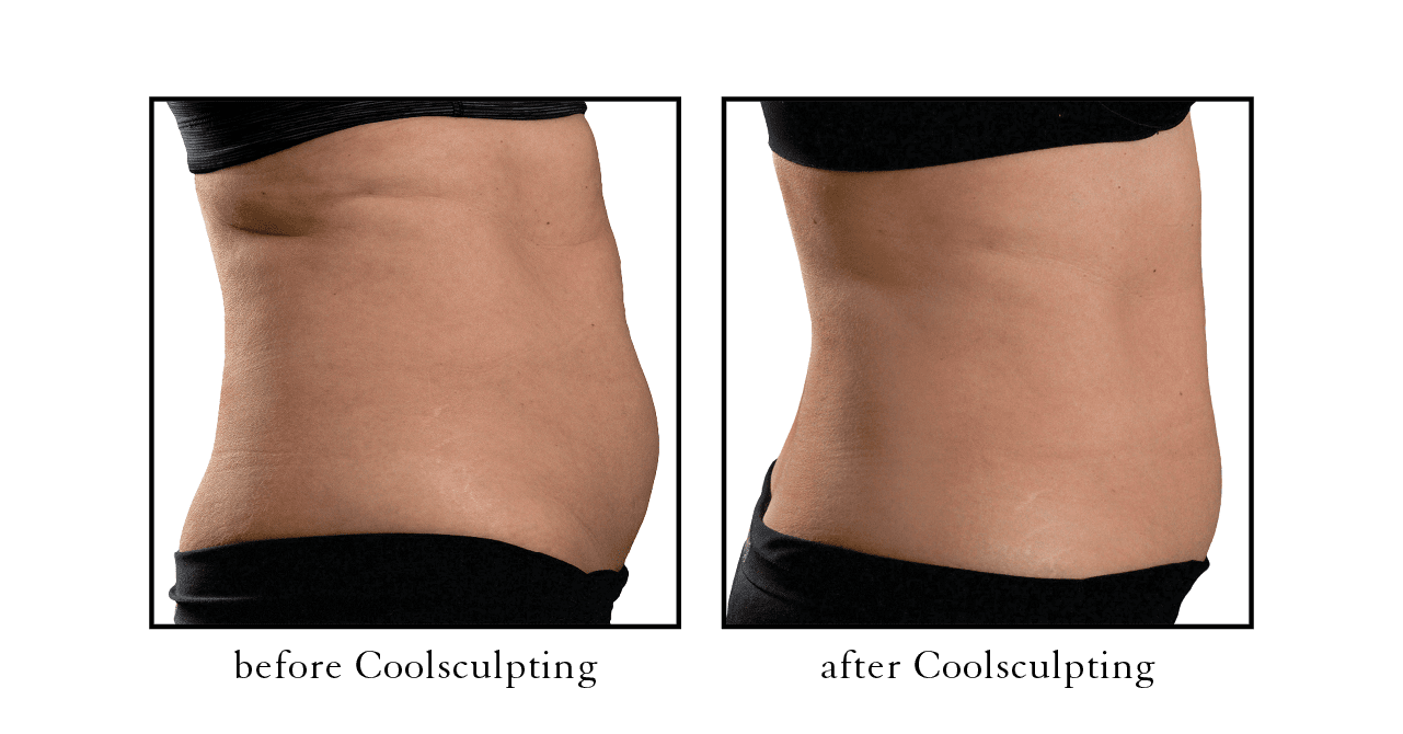 Is CoolSculpting Permanent? - The Cosmetic Vein & Laser Center