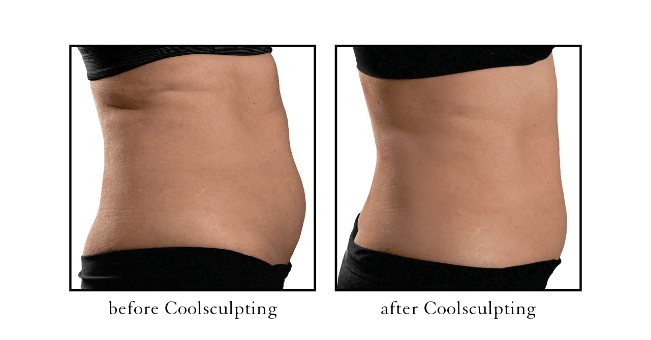 coolsculpting results coolsculpting results