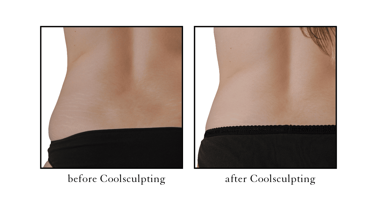 Coolsculpting - Dr. Gustav Lo