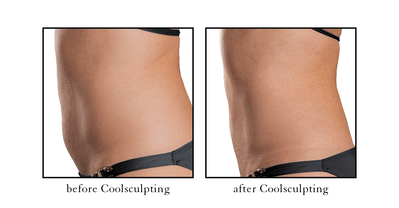 Coolsculpting Before And After - Shaping My Waist - Whistler