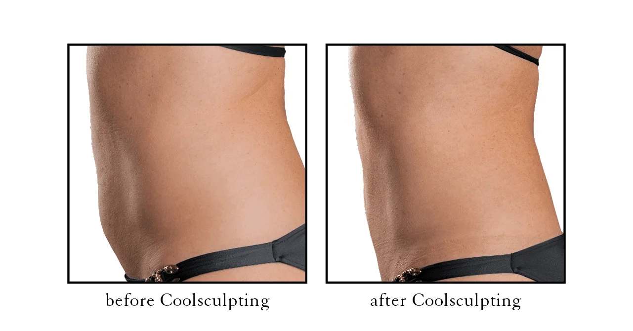 coolsculpting results5 coolsculpting results