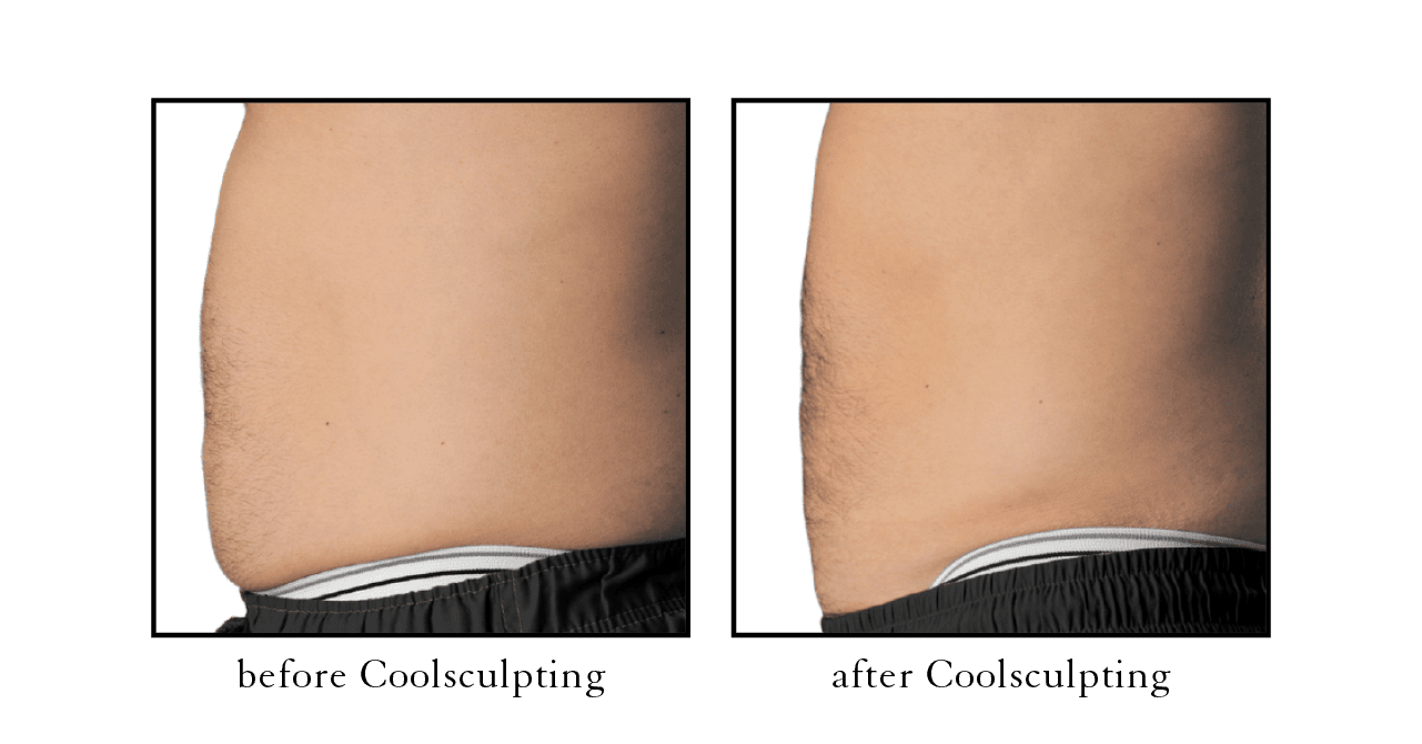 How to Get Rid of Back Fat with CoolSculpting - The Cosmetic Skin