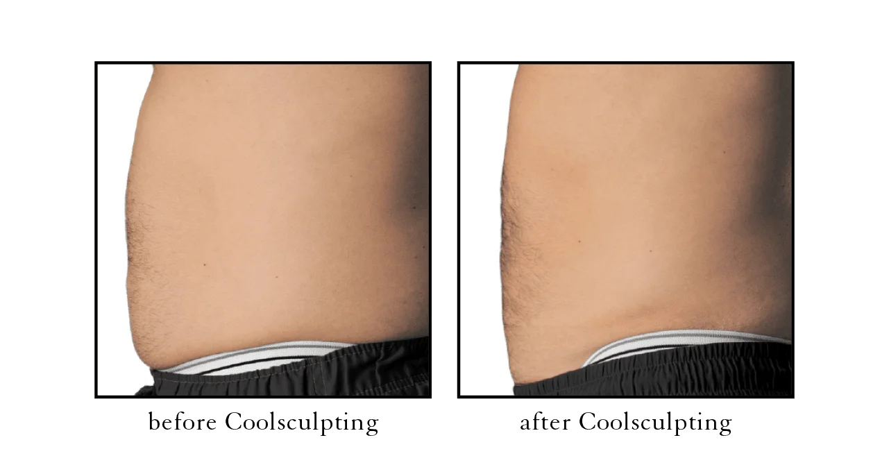 coolsculpting results8 coolsculpting results