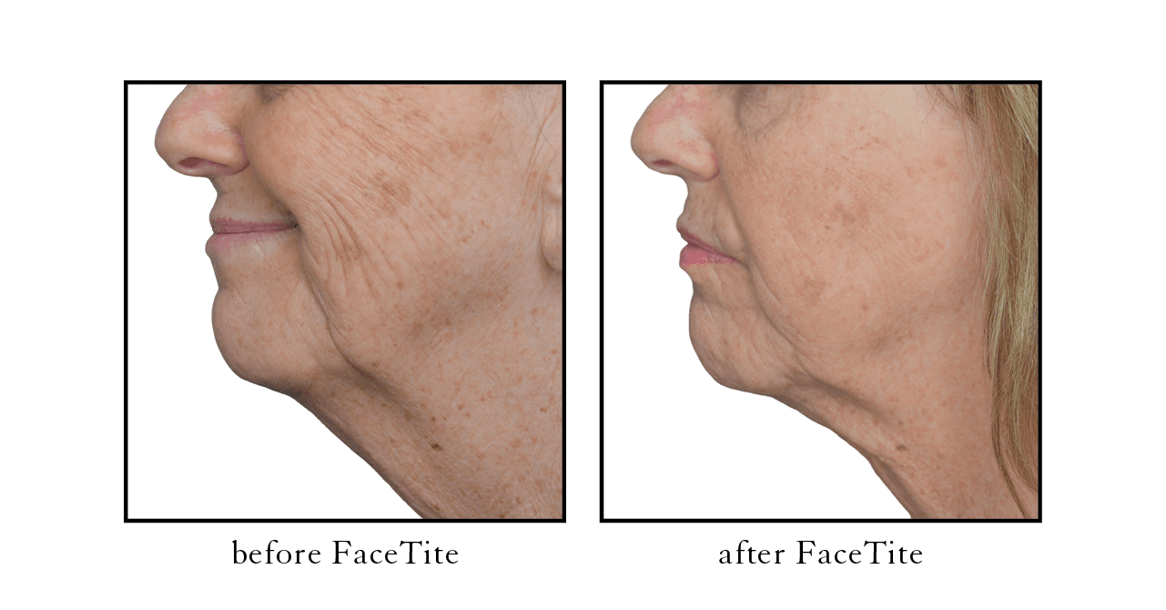 facetite before after
