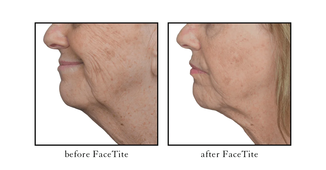 facetite before after facetite before after