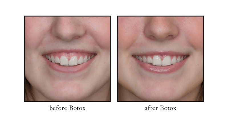 Botox before and after for gummy smile treatment showing reduced gum visibility at CSLC