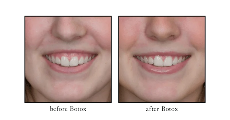 Botox before and after for gummy smile treatment showing reduced gum visibility at CSLC