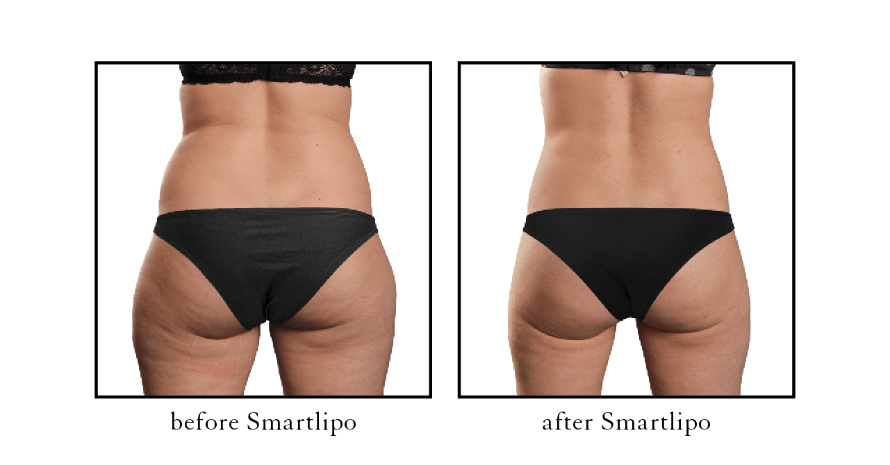 Smartlipo Male Jaw Sculpting: What Are The Benefits?