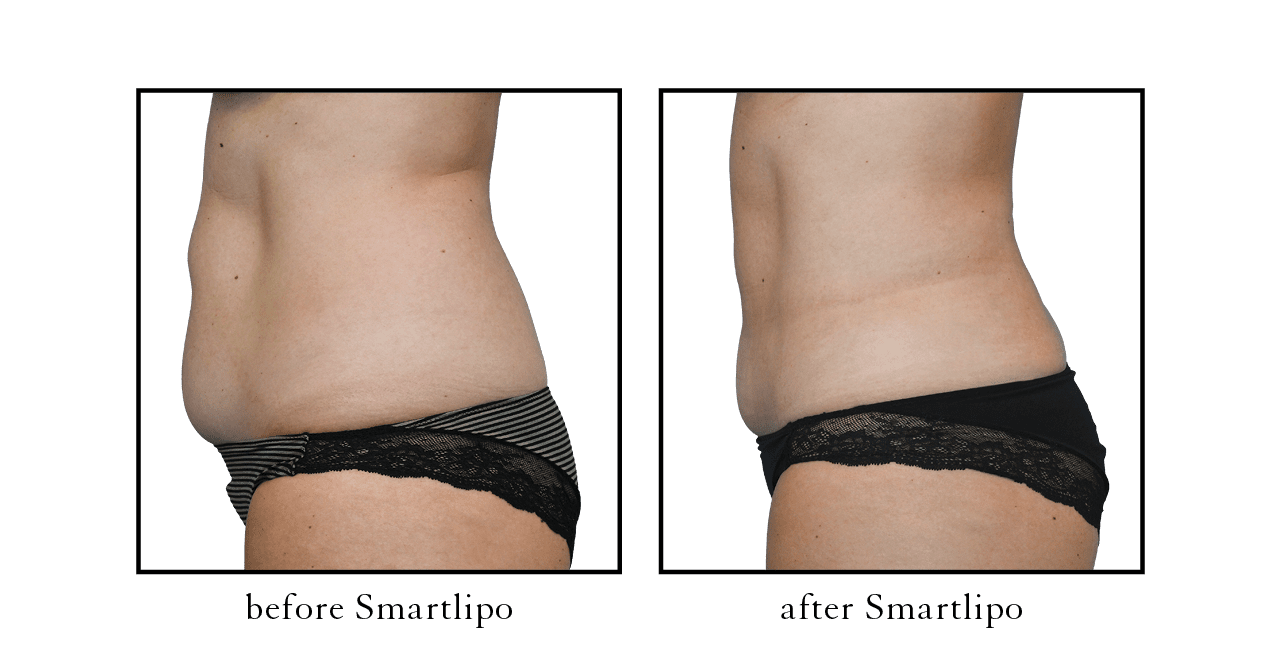 What is the Best Body Contouring Treatment? SmartLipo or CoolSculpting