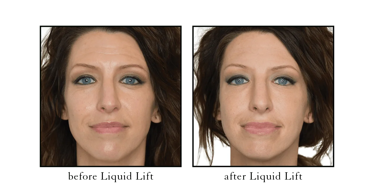 liquid lift before after