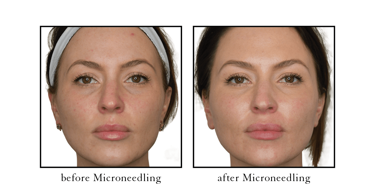 microneedling