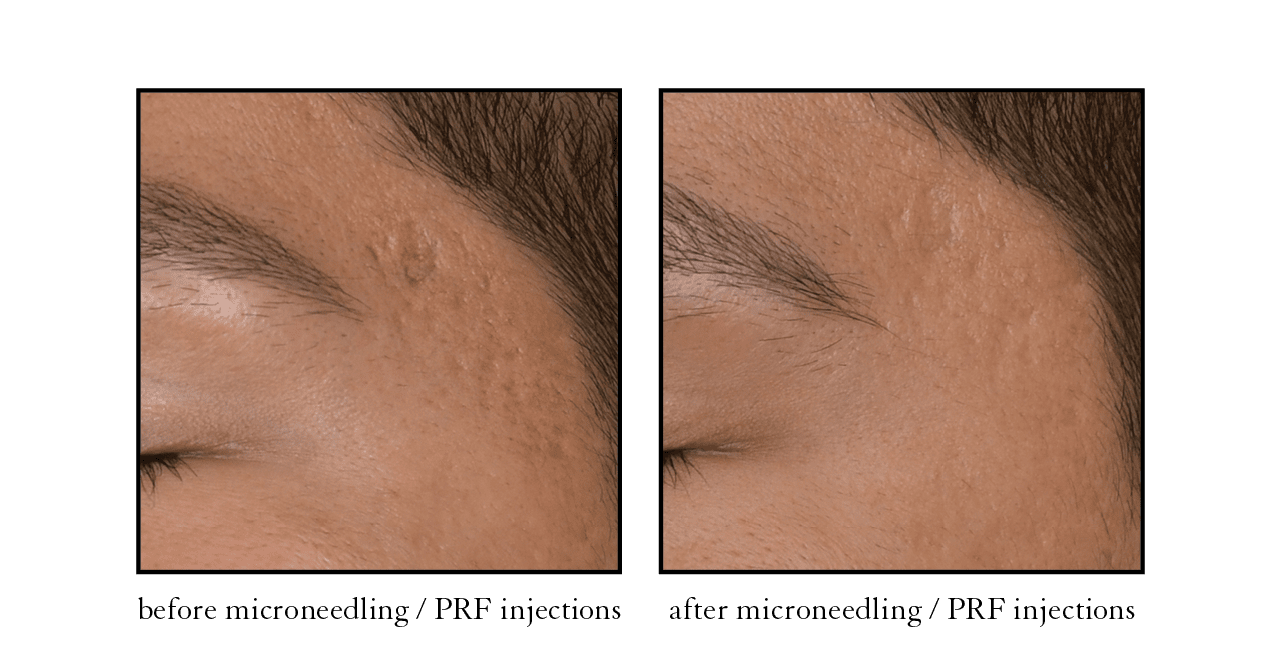 microneedling prf