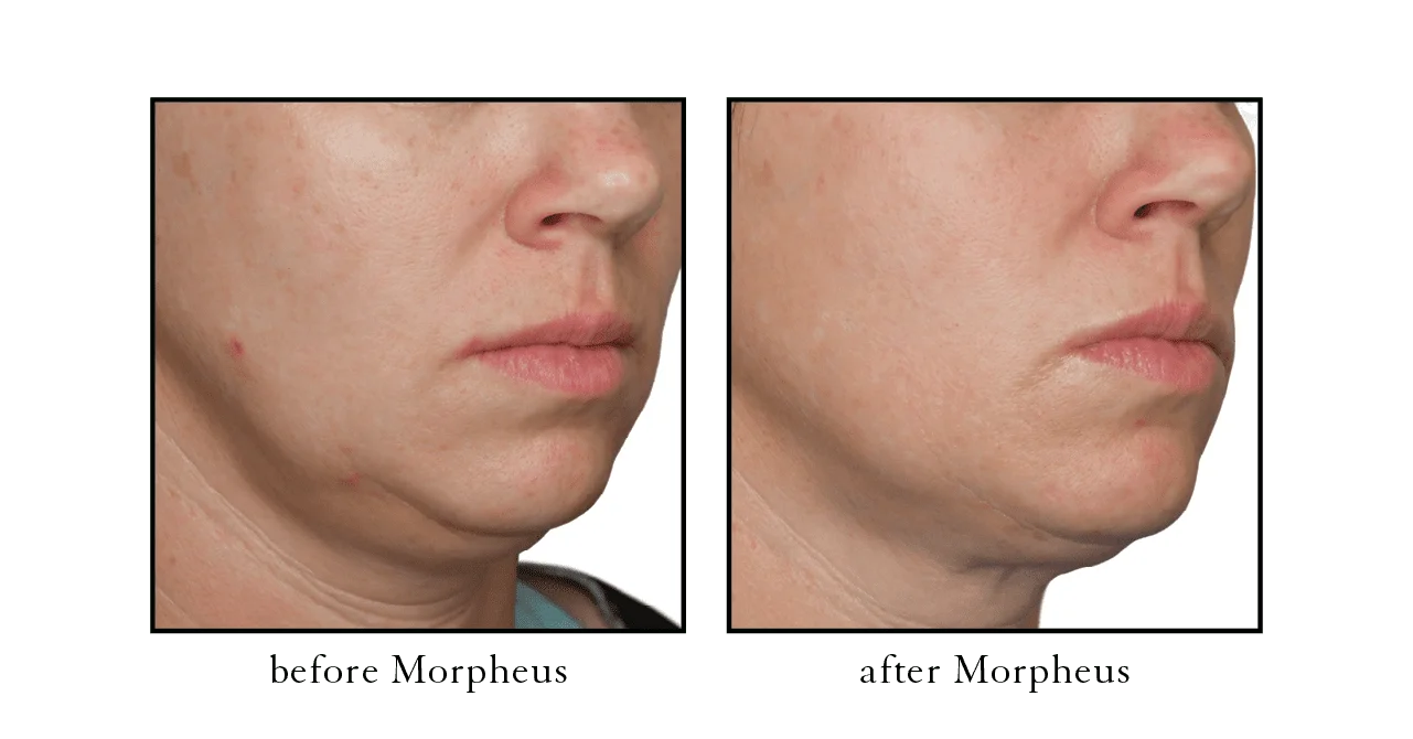 morpheus face