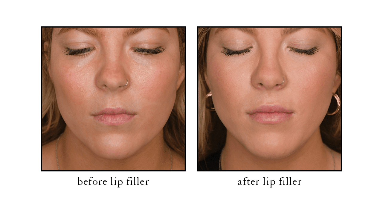 CSLC naples filler lip filler