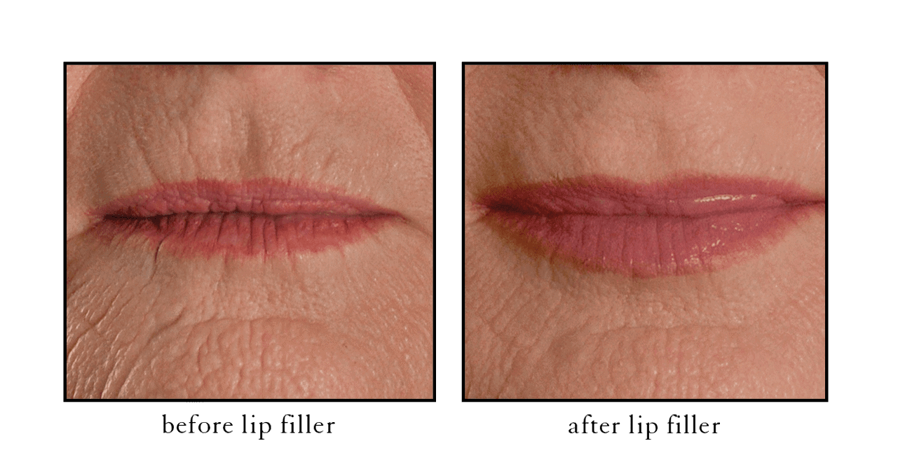 CSLC naples filler lip filler