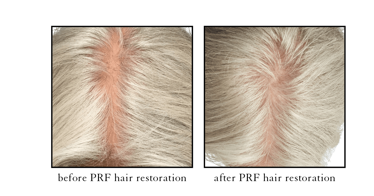 Prf Hair Restoration Before and After  Sculpt MD Medspa