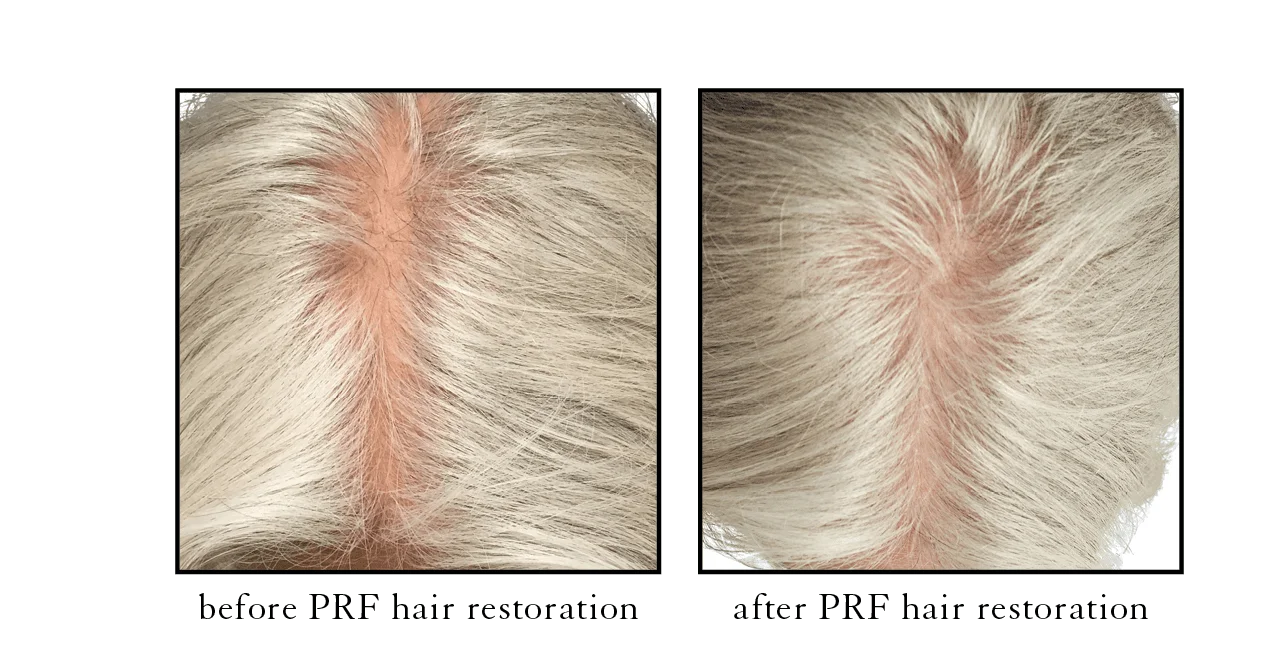 PRF hair restoration