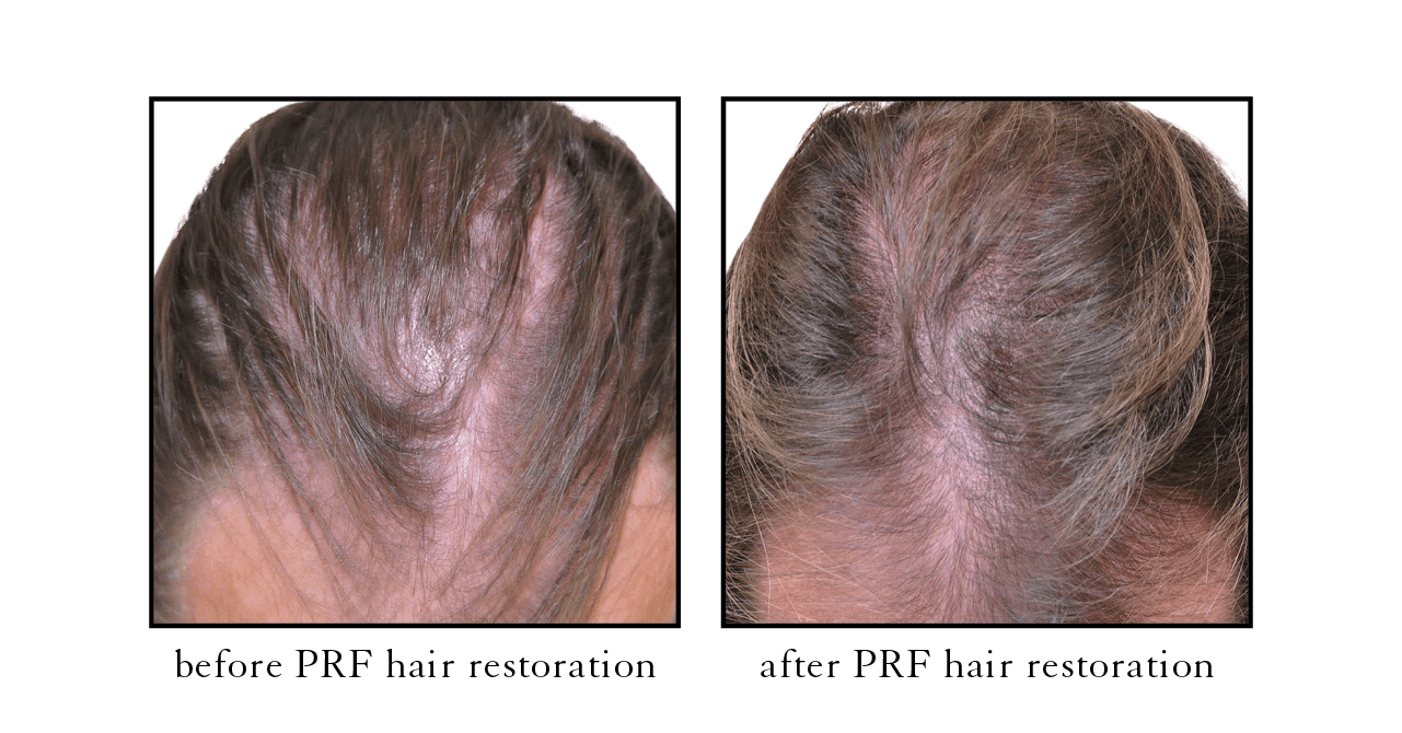 PRF hair restoration
