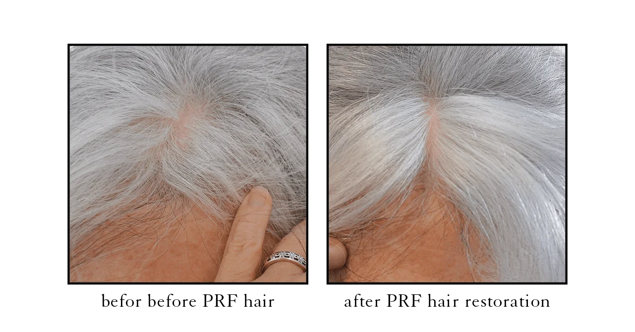 PRF hair restoration