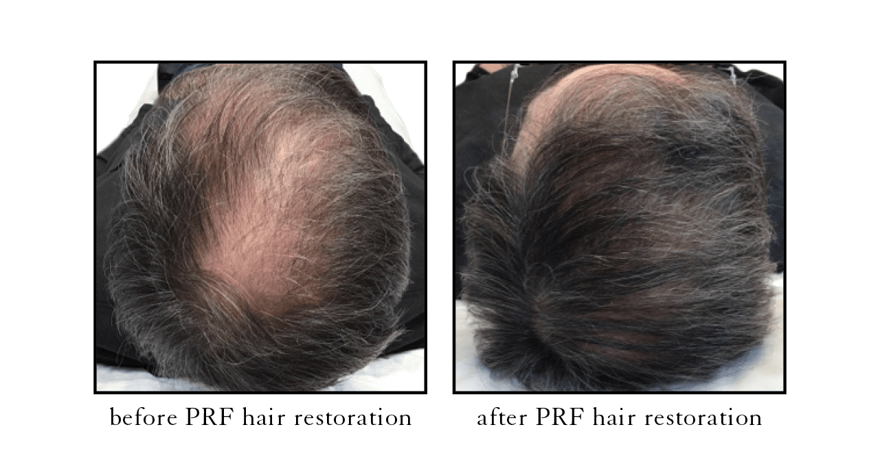 PRF vs PRP for Hair Loss  Beautifully New