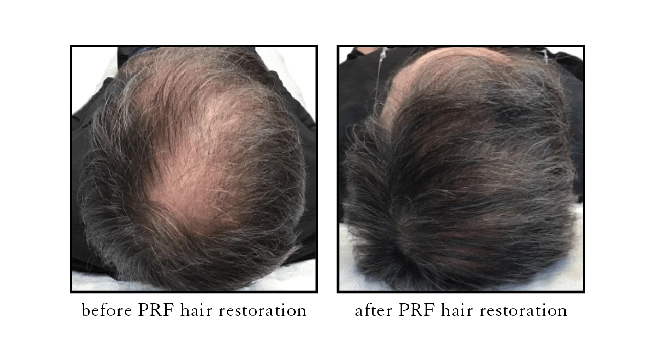 PRF hair restoration