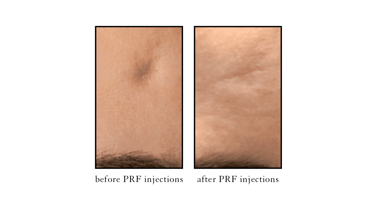prf injections
