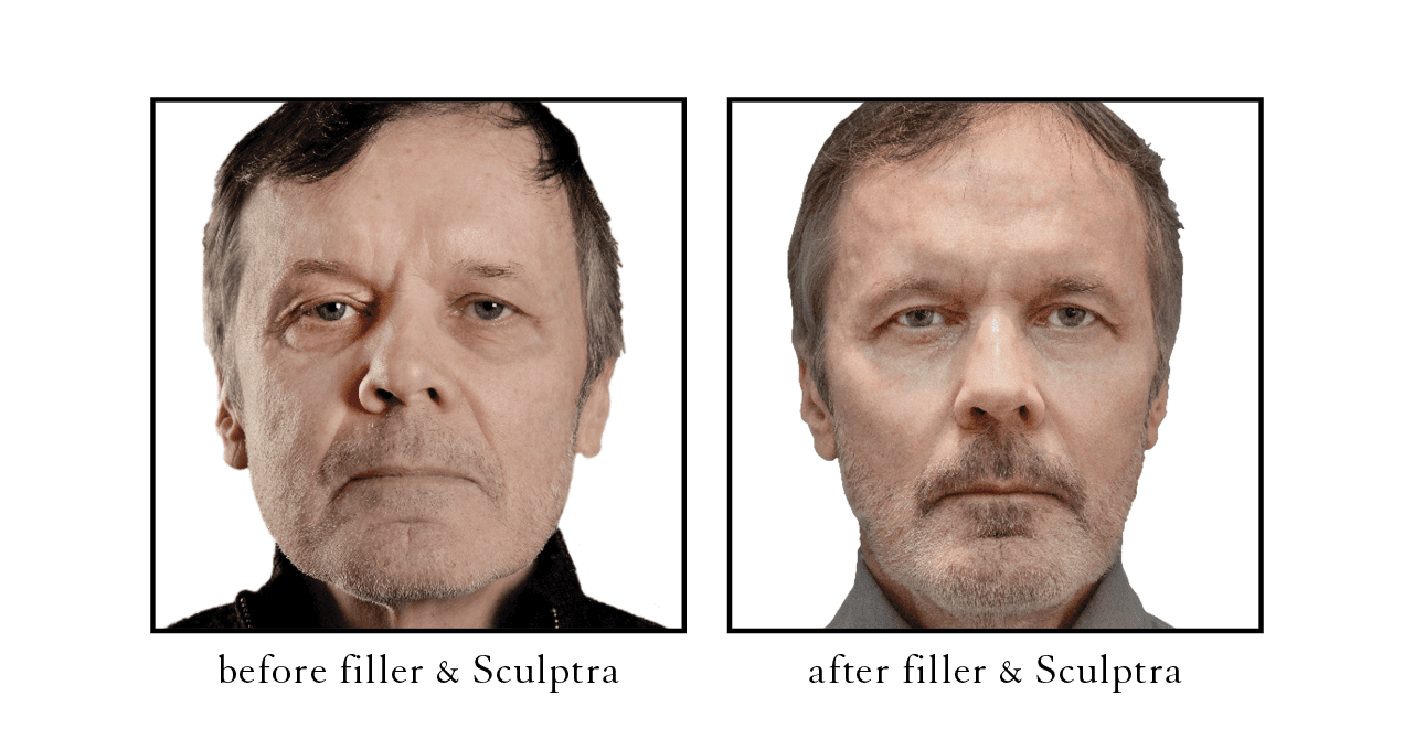 sculptra