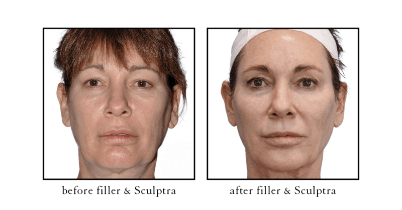 Sculptra | Cosmetic Skin & Laser Center