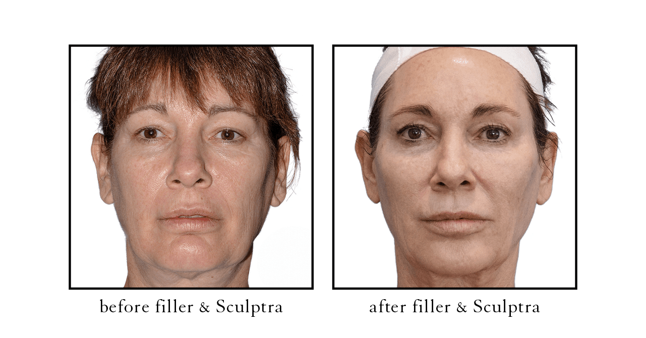 sculptra