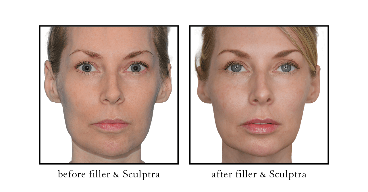 Sculptra®  Naples, Ft. Myers, Bonita Springs & Estero