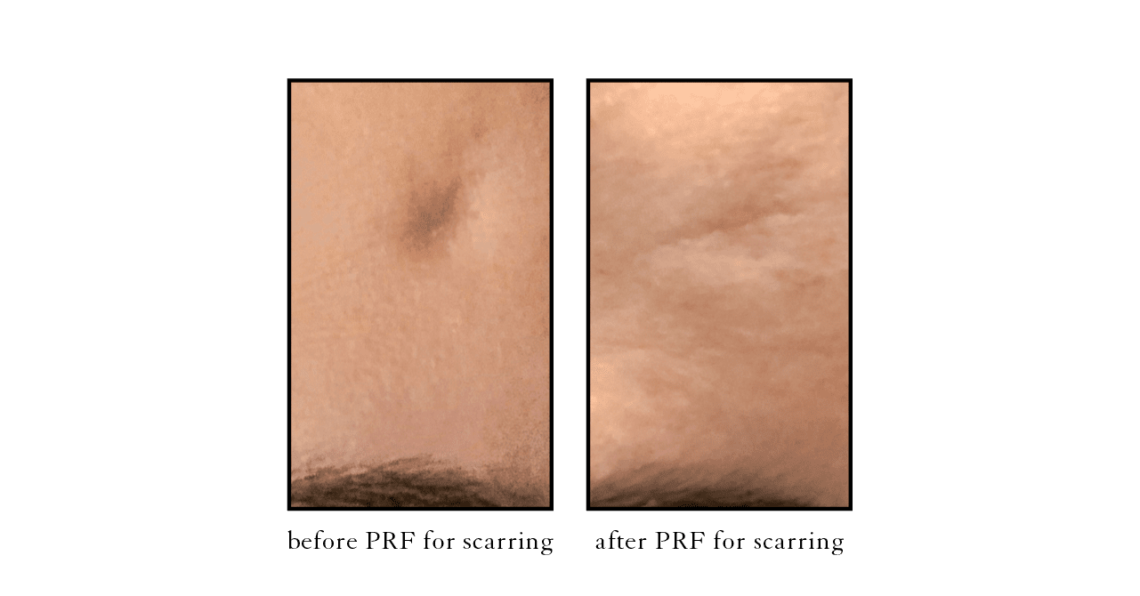 PRF scarring