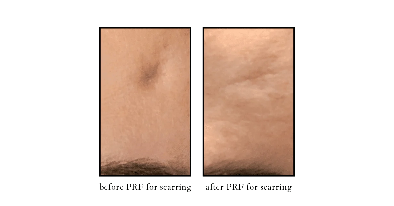 PRF scarring PRF scarring