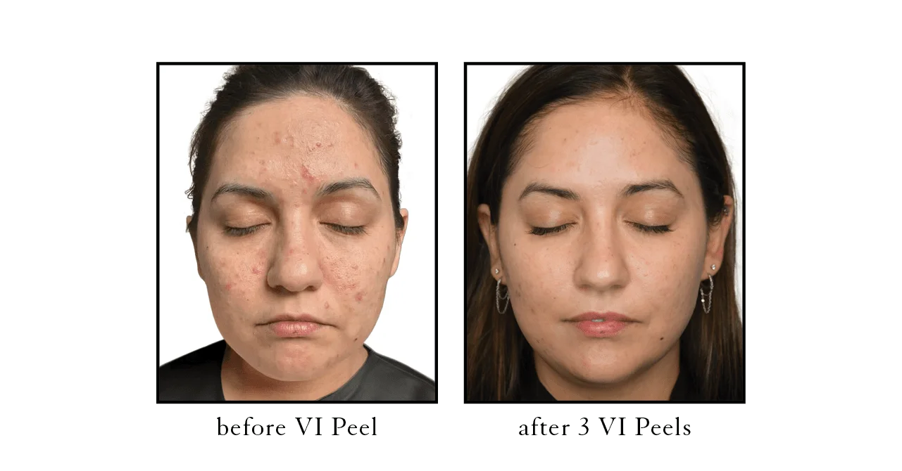 Acne & Mascne Treatments  Cosmetic Skin & Laser Center