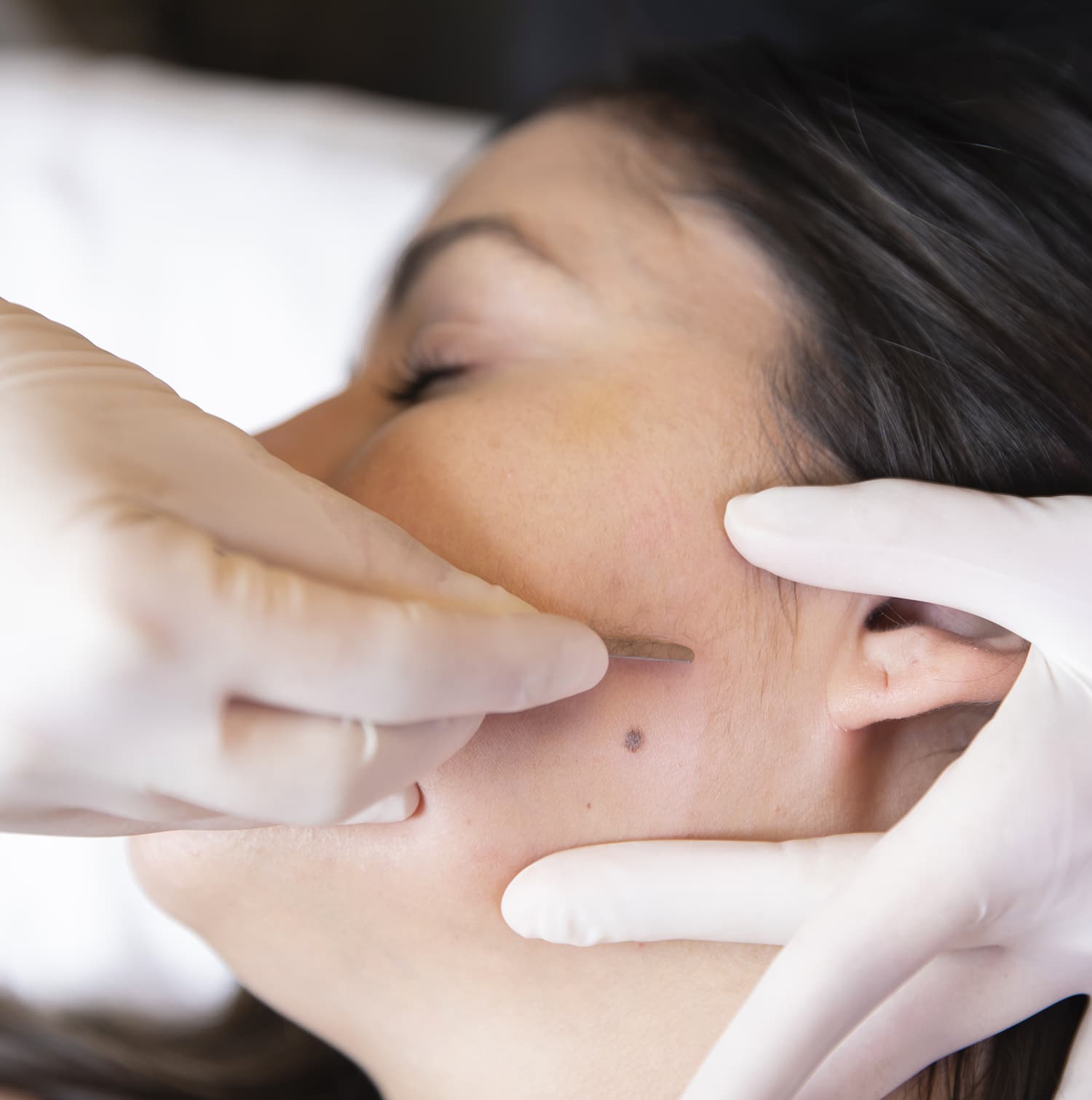 dermaplaning CSLC dermaplaning CSLC