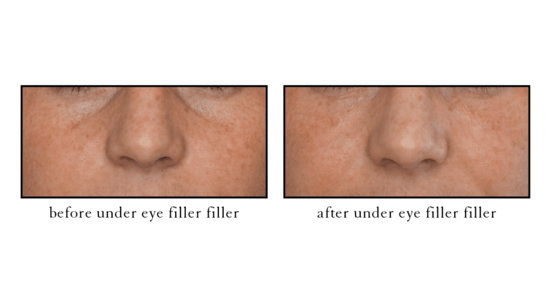 Tear trough filler before and after photo showing improved under-eye appearance at Cosmetic Skin and Laser Center