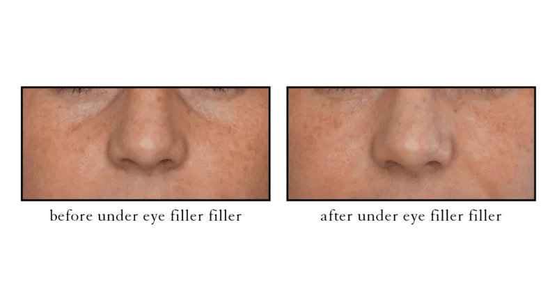 Tear trough filler before and after photo showing improved under-eye appearance at Cosmetic Skin and Laser Center