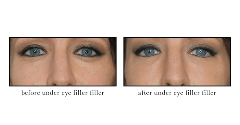 Under-eye filler before and after results showing reduced tear trough hollowing at CSLC