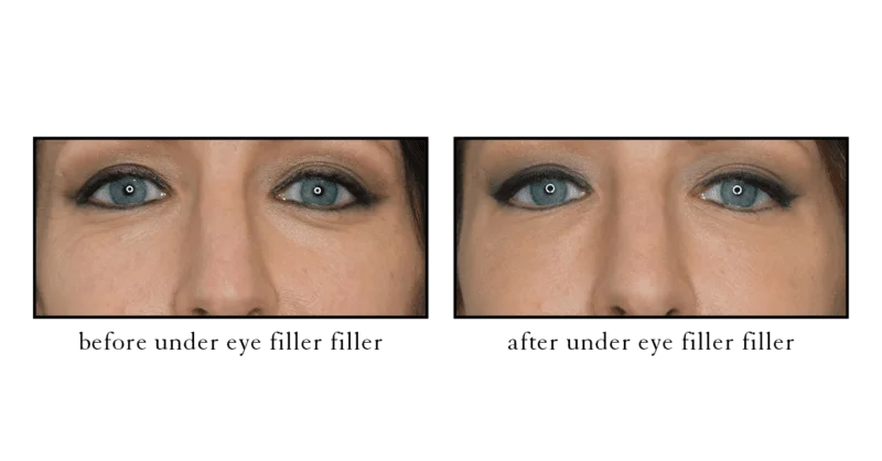 Under-eye filler before and after results showing reduced tear trough hollowing at CSLC