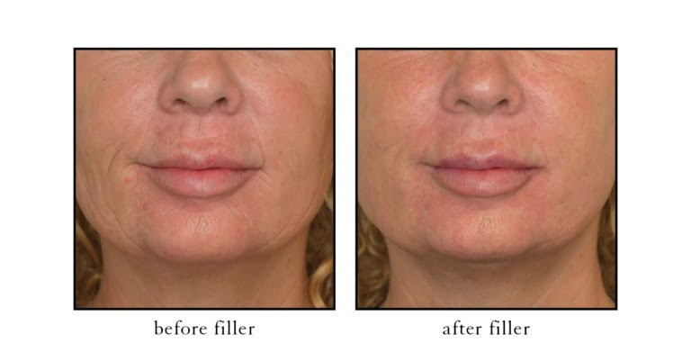 filler before and after photos