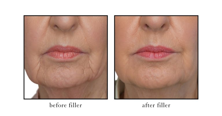 filler before and after photos
