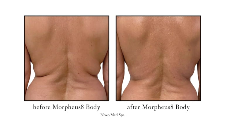 morpheus8 body before and after photos