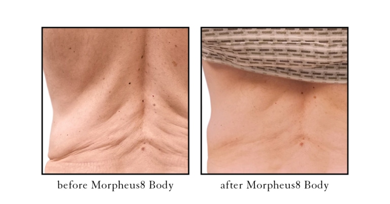 morpheus8 body before and after photos