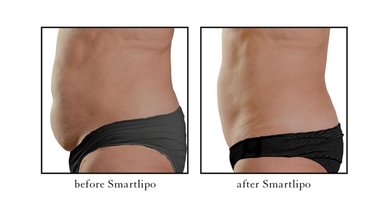 smartlipo before and after photos