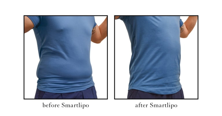 smartlipo before and after photos