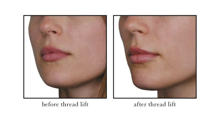 thread lift before and after photos