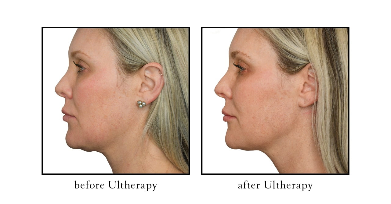 ultherapy before and after photos