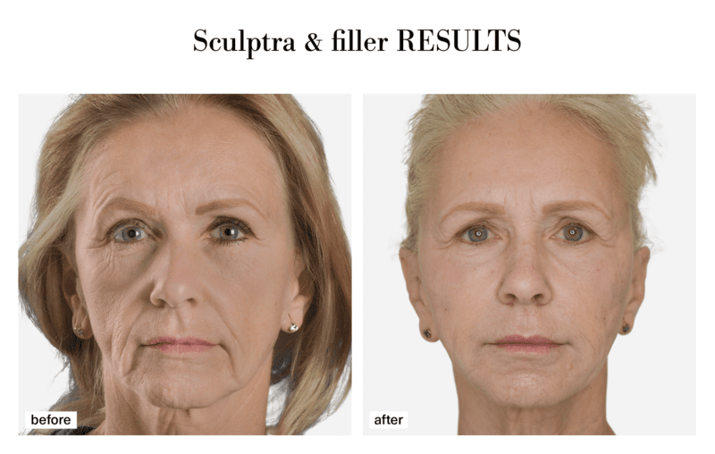 Sculptra before and after at CSLC