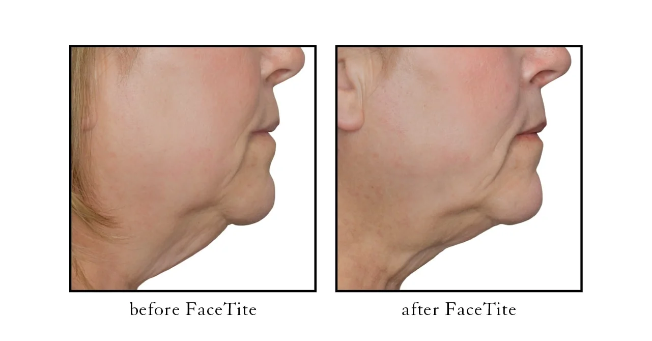 facetite before and after photos