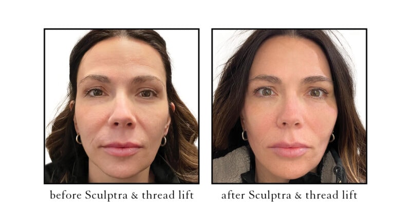 Sculptra | Cosmetic Skin & Laser Center